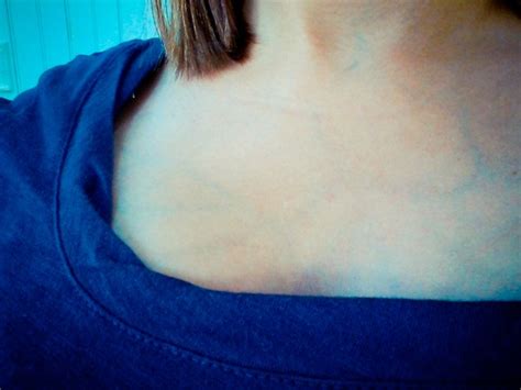 blue veins  breasts  health advisor
