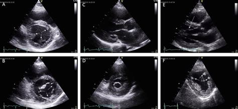 A Retrospective Analysis Of Mitral Valve Pathology In The