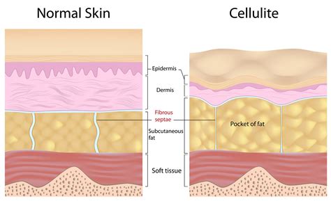 cellulite facts and myths hair transplant and aesthetic clinic in