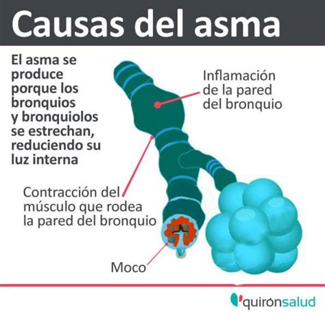 causas del asma  como identificarlo tu canal de salud