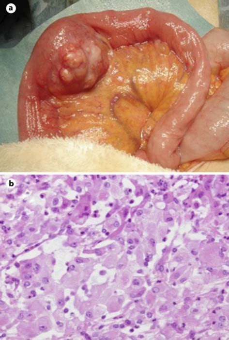 figure 2 malignant peritoneal mesothelioma mimicking ischemic colitis
