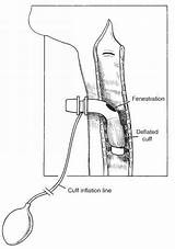 Tracheostomy Fenestrated Tube Trachea Cuff Tubes Deflated Fenestration Placement Cuffed Proper Figure Bronchi Plugged Vocalization Opened Allow sketch template