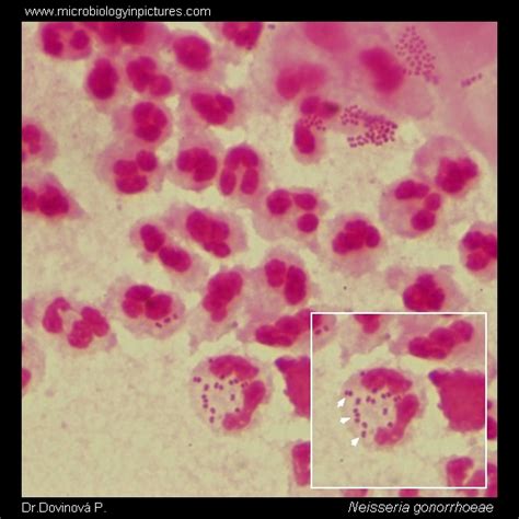 Neisseria Gonorrhoeae Gram Stain Neisseria Gonorrhoeae In Urethral