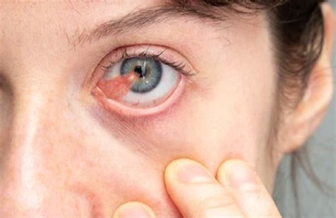 bubble  eyeball  diagnosis treatment myvisionorg