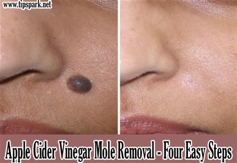 apple cider vinegar mole removal tips park beauty mole removal apple cider vinegar mole