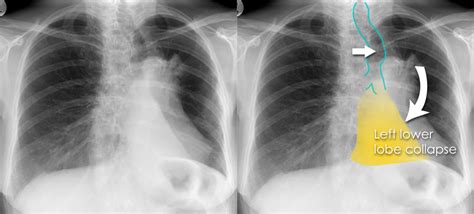 Chest X Ray Airways And Lung Collapse Left Lower Lobe Collapse