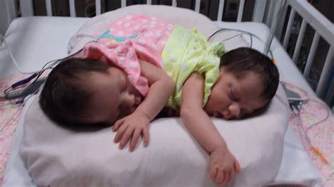 Conjoined Twins Are Headed Home From Houston Abc7 Los Angeles