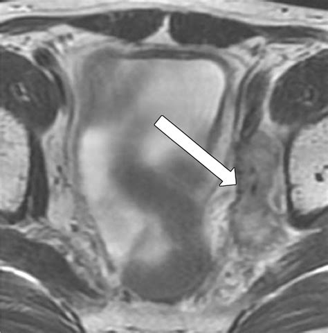 Mri Of Rectal Cancer Tumor Staging Imaging Techniques And Management