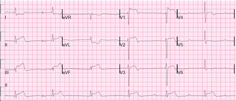 Acls Refresher Acs And Bradycardia Emergency Medicine Kenya Foundation