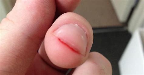 Paper Cut Under Fingernail Imgur