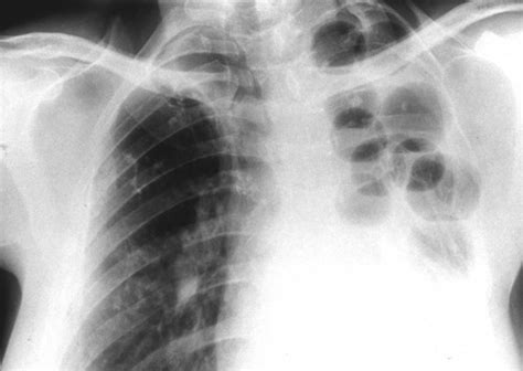 Pulmonary Infections Radiology Key