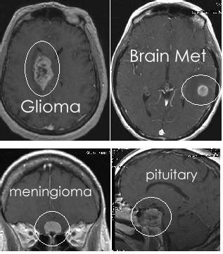 brain anatomy  images gross