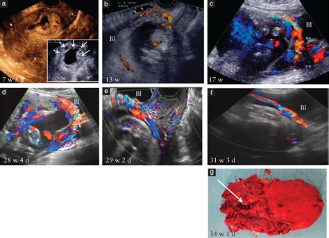 cesarean scar pregnancy is a precursor of morbidly adherent placenta timor‐tritsch 2014