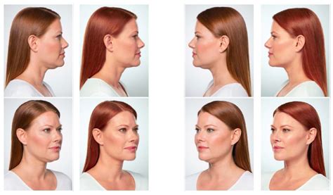 v line jaw slimming using kybella™ and masseter injection with botox