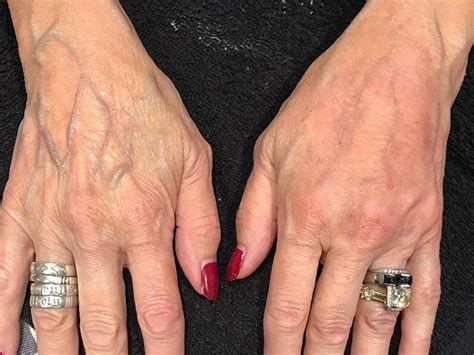 fda approves dermal fillers for hands so you can have ageless mitts