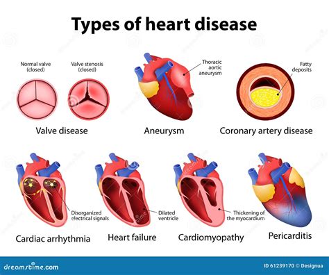 heart valve disease diagram