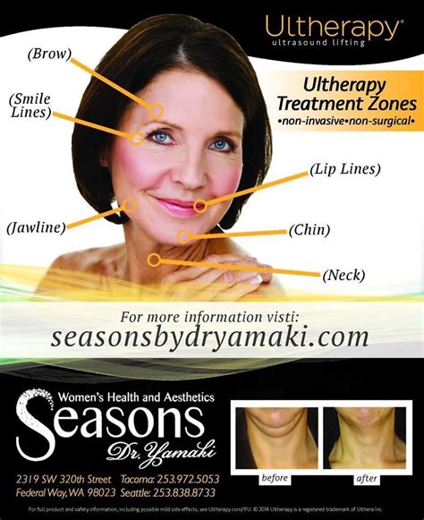 pin  seasons  dr yamaki  ultherapy ultherapy    lips