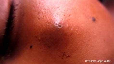 Facial Cysts Pictures Anal Sex Movies