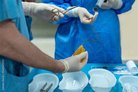 penis penile implant penis enlargement surgery balloon insertion