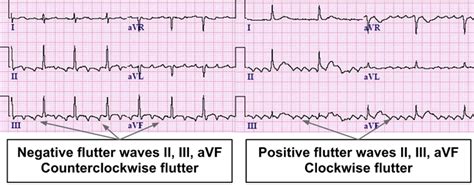 atrial flutter review