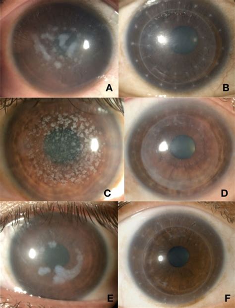 Long Term Clinical Outcomes Of Keratoplasty Using Gamma Irradiated