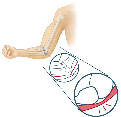 puc sulcus ulnaris syndrom schonende diagnose mit hd ultraschall