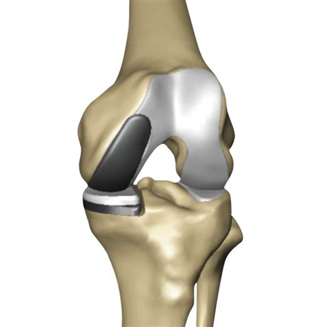 partial knee replacement nolan  maher md