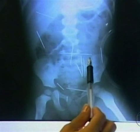 craziest x rays how did that get in there x ray bizarre body
