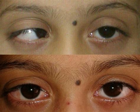 paediatric ophthlmology  squint aarna eye care center
