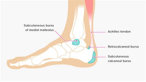 bursitis ankle bursa care  prevention