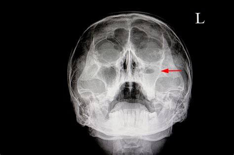 Sinus X Ray Why Is Performed And Results
