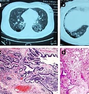 Image result for Zystisch adenomatoide malformation der Lunge. Size: 174 x 185. Source: diagnosticpathology.biomedcentral.com