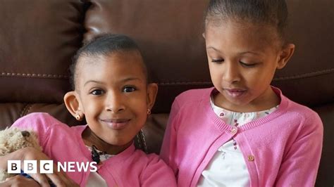 conjoined twins sisters meet surgeons who separated them bbc news