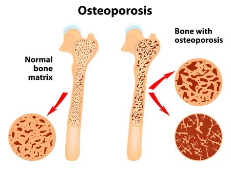 osteoporosis an overview and early warning signs seniors and elderly