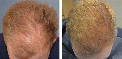 grafts hair transplant coverage costs results