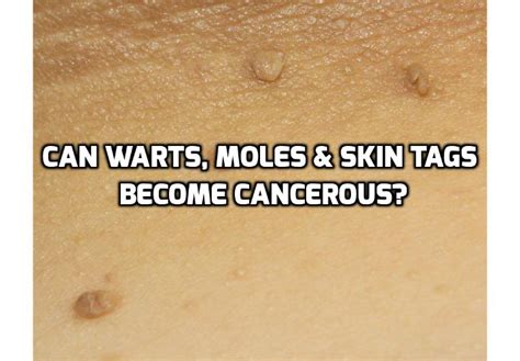 can warts moles and skin tags really cause cancerous growth
