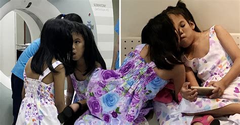 Conjoined Twins Prepare For Separation Surgery That May Only Save One