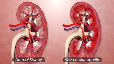 glomerulonephritis causes symptoms treatment urologists omaha