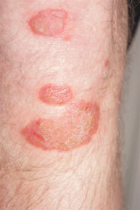 identifying  common red spots  skin universal dermatology