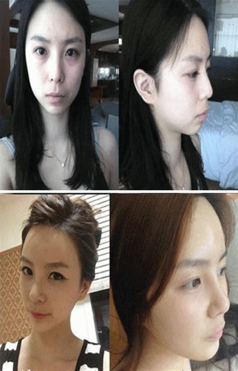 miracles do exist these 52 plastic surgeries in korea are beyond your imagination page 2 of 13