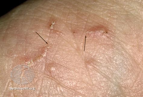 scabies the london skin and hair clinic