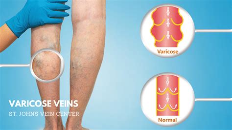 Varicose Veins Causes Prevention Treatment Options
