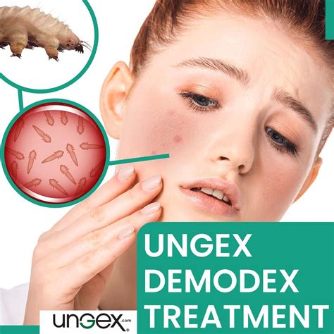 demodex treatment ungex demodex treatment demodex demodex
