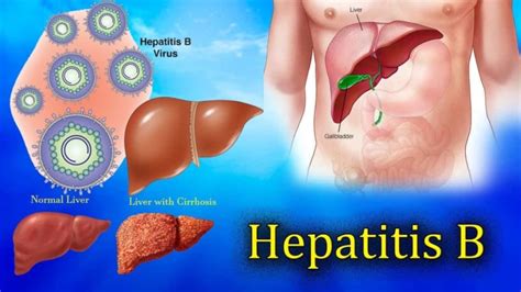 Hepatitis B Causes Symptoms Treatments And More