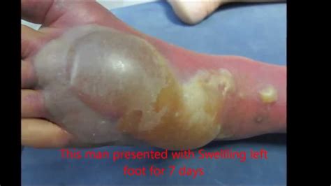 cellulitis foot with blister youtube
