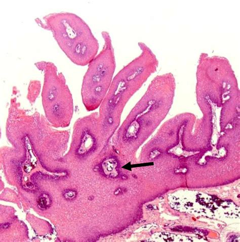 cureus unusual manifestation  benign squamous papilloma