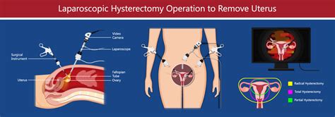 laparoscopic assisted vaginal hysterectomy north texas
