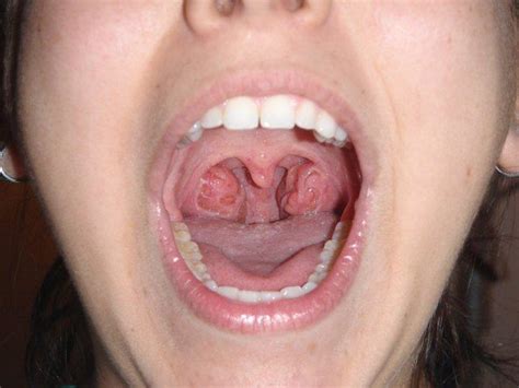 My Tonsils These Are My Tonsils Not Swollen Up Or Infected… Flickr