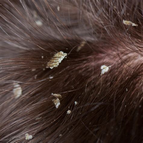 itchy facts  dandruff gethair