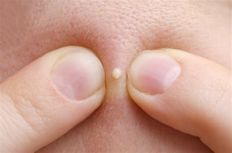 The Scientific Reason People Love Pimple Popping Videos Live Science